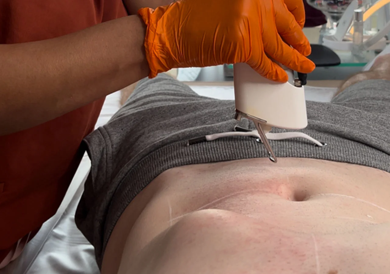 Laser hair removal in progress on the torso at WILD.