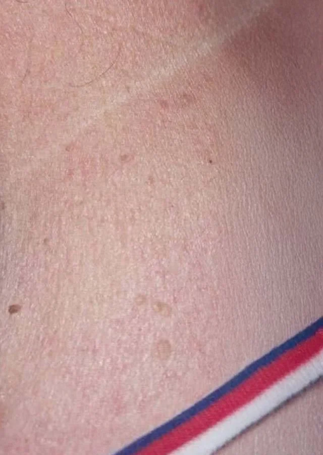 Skin after treatment of two raised lesions