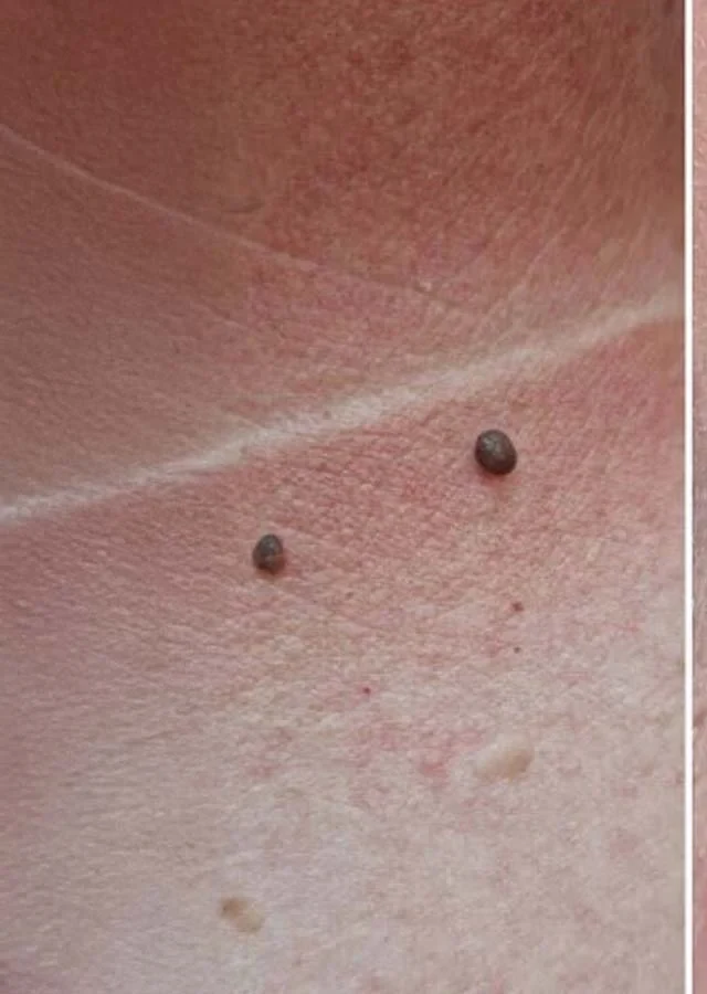 Skin before treatment, two raised lesions