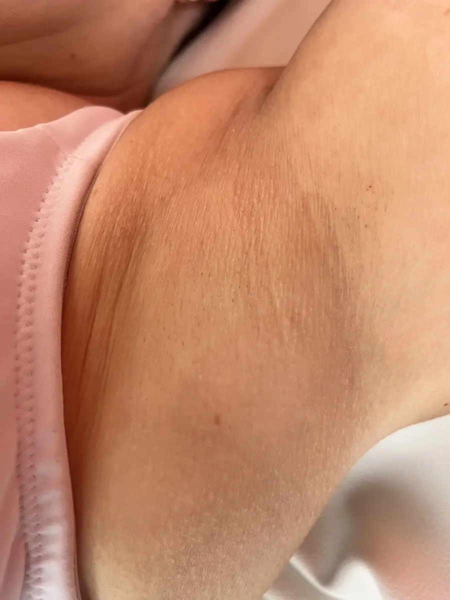 Underarm skin after a course of redness and rosacea reduction at WILD, calm and even