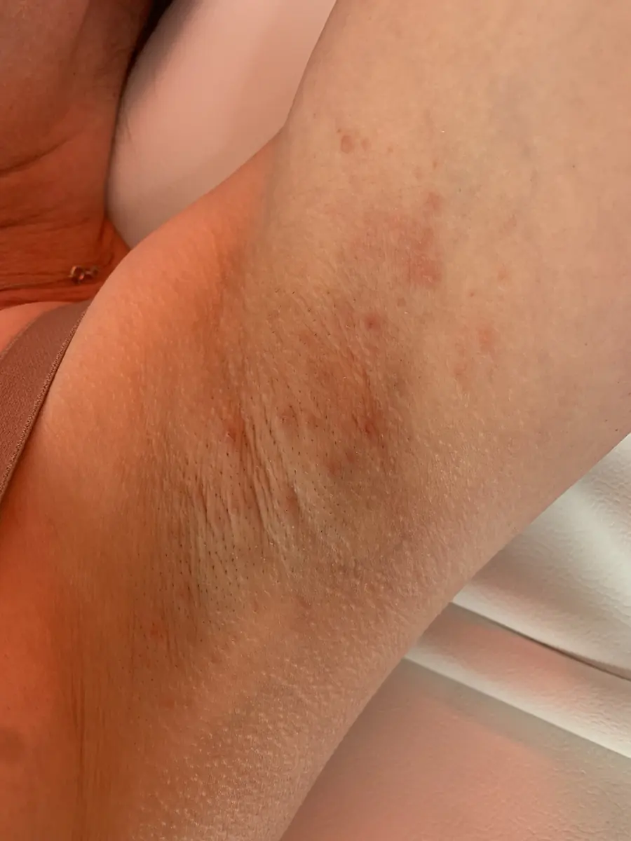 Underarm skin before treatment, showing patches of redness