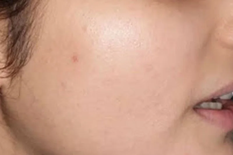Cheek and jawline after a course of laser hair removal at WILD
