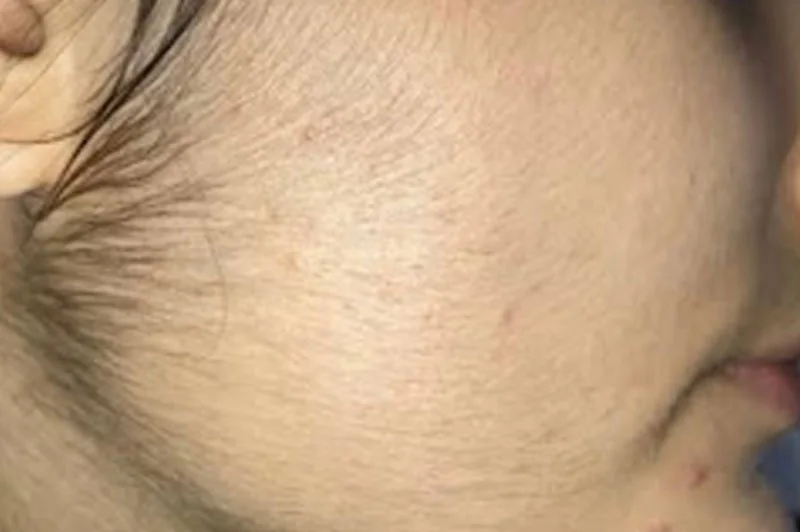 Cheek and jawline before laser hair removal at WILD