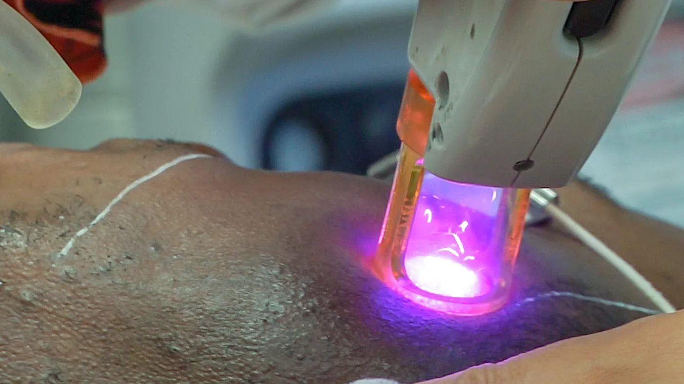 A laser epilation handpiece treating the skin.