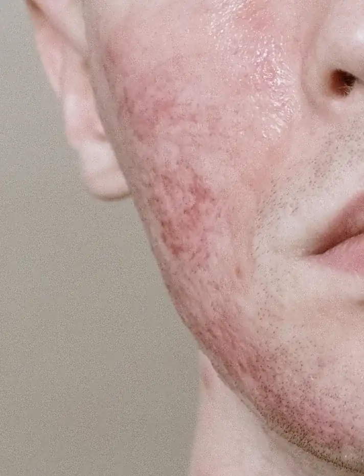 Close-up of a cheek with rosacea redness before treatment at WILD.