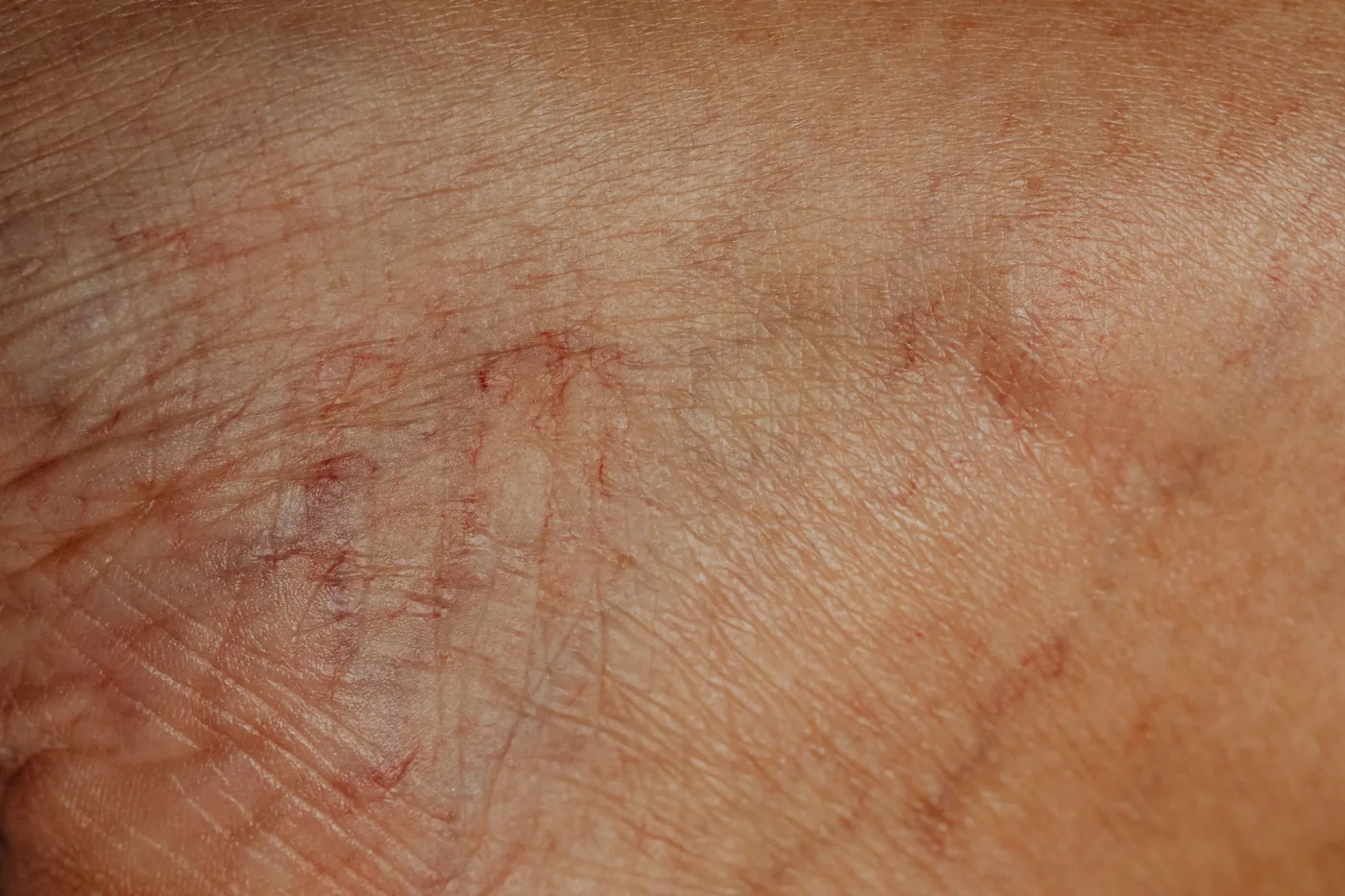 Close-up of skin showing fine lines and wrinkles.